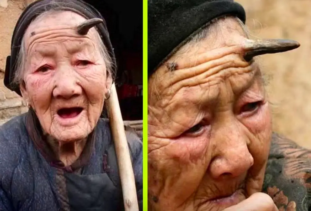 Perempuan 101 Tahun Miliki Tanduk Hitam di Dahi, Tumbuh Hampir 6 Sentimeter