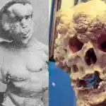 Kisah Tragis Joseph Merrick, Manusia Gajah yang Tak Bisa Tidur Berbaring