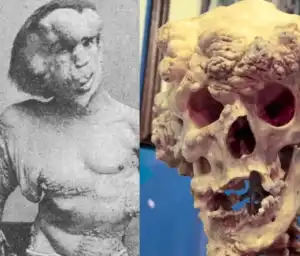 Kisah Tragis Joseph Merrick, Manusia Gajah yang Tak Bisa Tidur Berbaring